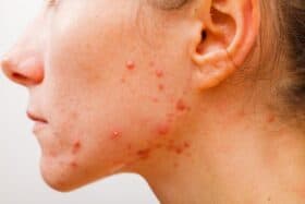How to quickly get rid of cheek acne?