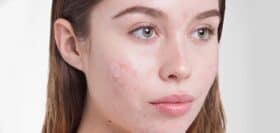 Guide on what causes cystic acne